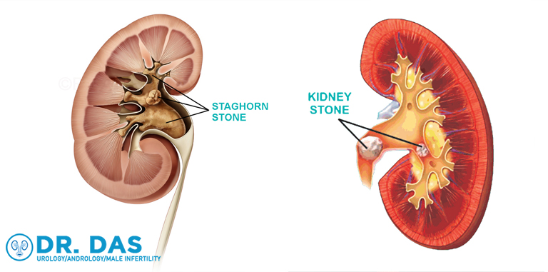 Kidney Stone Treatments In Bahrain