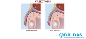 diagram of before and after vasectomy